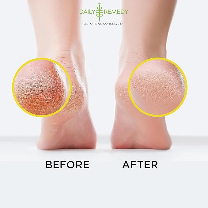 Citrus Detox Foot Soak with Epsom Salt - for Foot Callus, Immune Boost, Damaged Toenail, Athletes Foot, Pedicure and Soothes Tired Feet - Made in USA