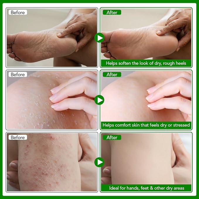 Meifenla Tea Tree Oil Balm,Premium Multi-Plant Complex Formula for Itching & Dry Skin - Moisturizing Care for Hands, Feet, Elbows & Knees | Non-Greasy For All Skin Types