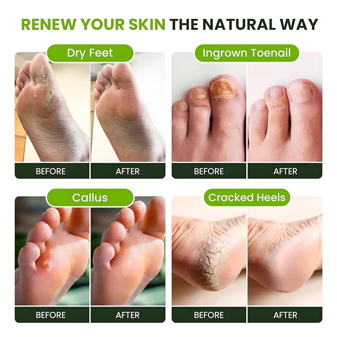 FOOT CURE Tea Tree Oil Foot Soak with Epsom Salts- for Foot Pain, Soreness, Athletes Foot, Odors, Toe Nail Fungus, Fungal, Calluses (Pack of 4)
