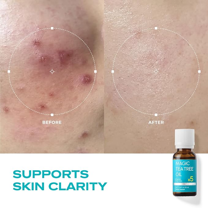 Magic Tea Tree Oil Spot Care for Face, Clarifying Facial Oil for Oily and Sensitive Skin, Lightweight and Fast Absorption, Vegan Korean Skincare, 0.68 fl oz (20ml)