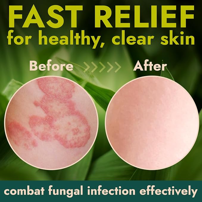 Antifungal Body Cream for Ringworm & Athlete’s Foot | Strength Formula with Tea Tree Oil | Helps With Itching, Burning & Scaling Relief | Treatment For Skin Fungus | 4.05 fl oz