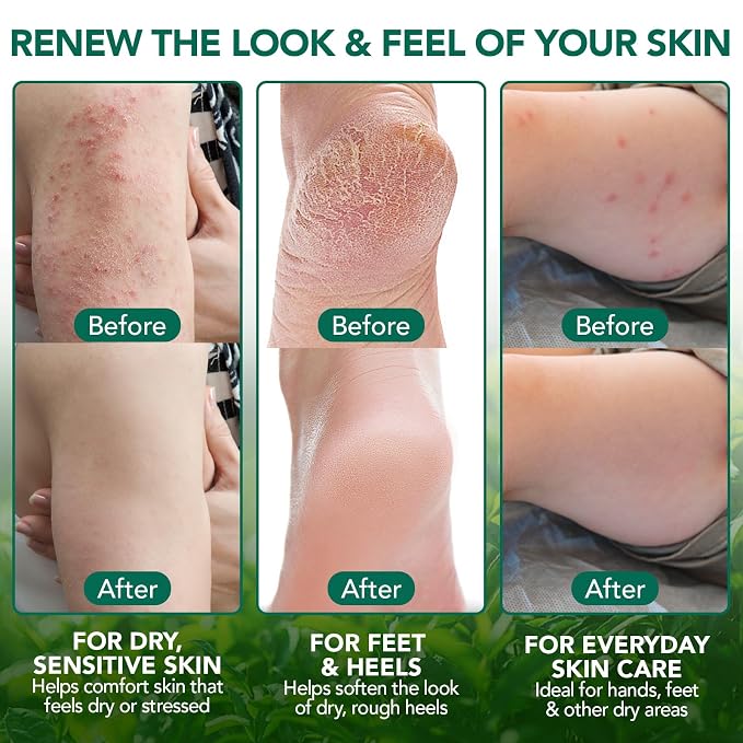 Tea Tree Oil Balm,Tea Tree Oil for Skin,Dry Itchy Skin & Rash Relief, Athlete’s Foot & Dry Feet Itching, Jock Itch, Chafing, Bug Bites,Natural Formula,Effective & Safe for All Ages