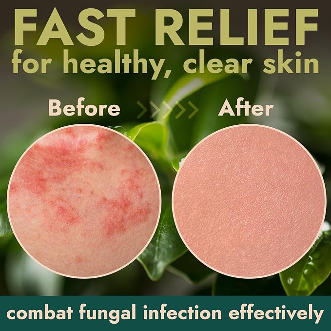 Antifungal Body Spray with Tea Tree Oil | Fast-Absorbing Antifungal Treatment for Jock Itch, Athlete’s Foot, Ringworm & Nail Fungus | Soothes Itching & Burning | Relieves Irritated Skin | 120ml