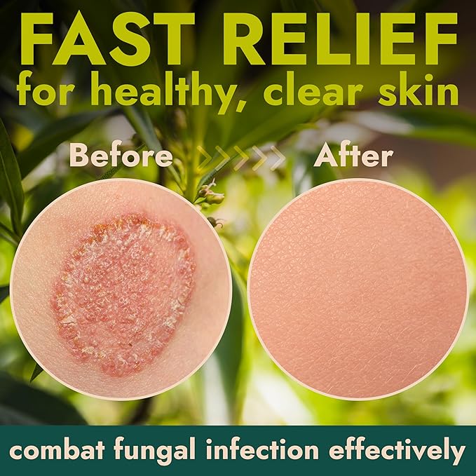 Antifungal Body Powder with Miconazole Nitrate 2% & Tea Tree Oil | Medicated Body Powder for Jock Itch, Athlete’s Foot, Ringworm & Odor | Soothes Itchy Skin | 3 oz, pack of 3