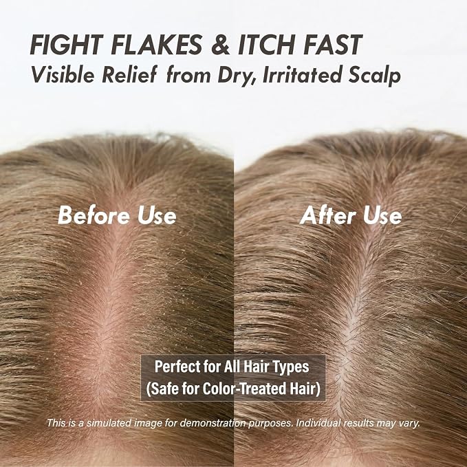 Scalp Serum Roll-On for Itchy & Thinning Hair: Instant Cooling Relief with Menthol & Lavender [Pack of 3] | Korean Scalp Care, Non-Sticky, Portable, Clinically Tested