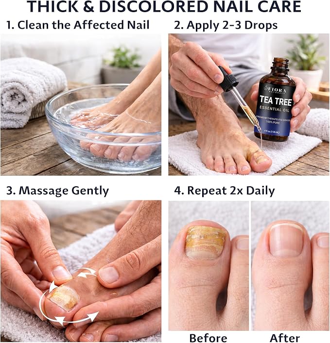 Fiora Naturals Tea Tree Oil 4 Fl Oz – 100% Pure Tea Tree Essential Oil for Skin, Face, Hair & Scalp Care, Nails & Toenails, Aromatherapy & Diffuser Use - Melaleuca Alternifolia